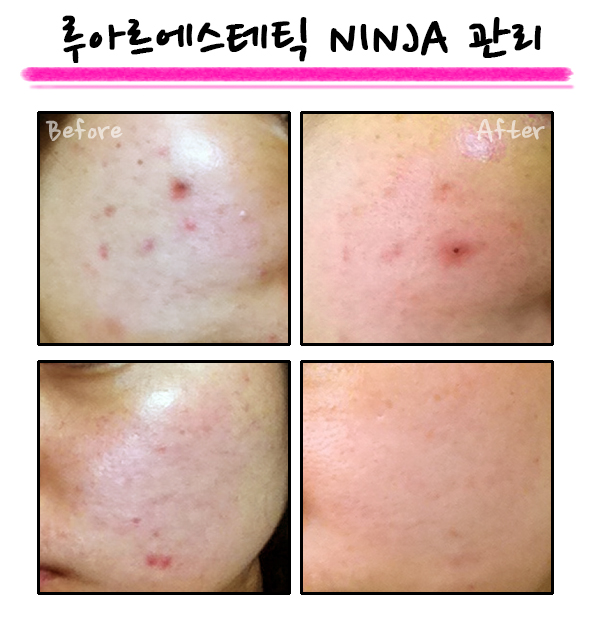 진피재생관리 닌자 2.jpg
