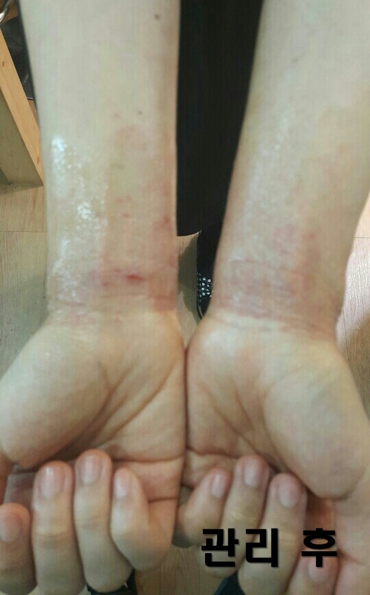 아토피후.jpg